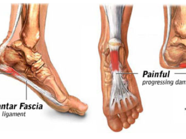 Clinical Pathology Plantar Fasciitis